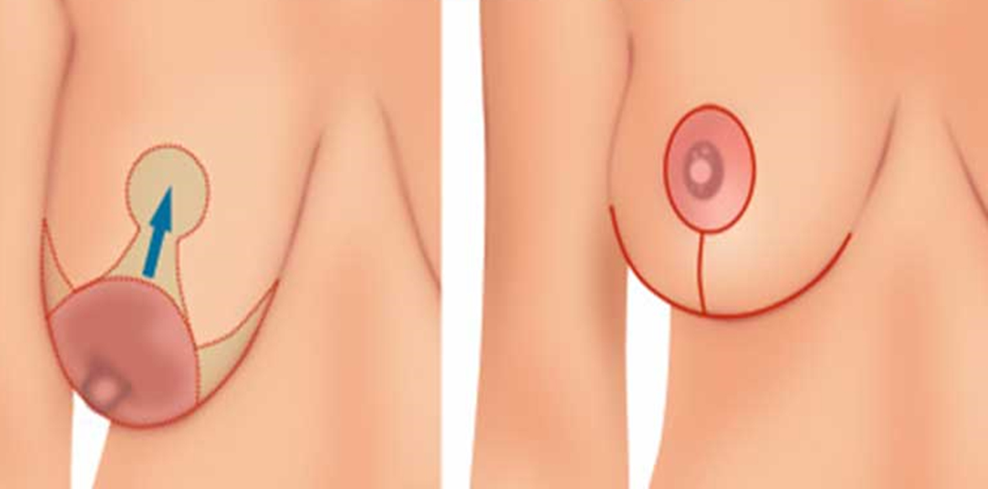 breast-firming-cream